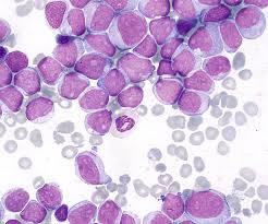 Peripheral smear of Acute Leukemias
